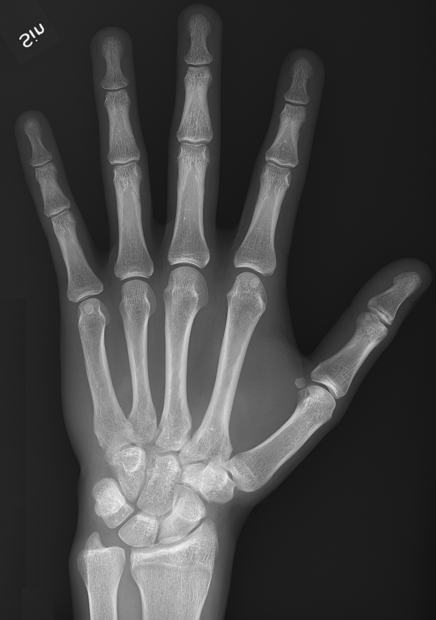 Hand radiograph
