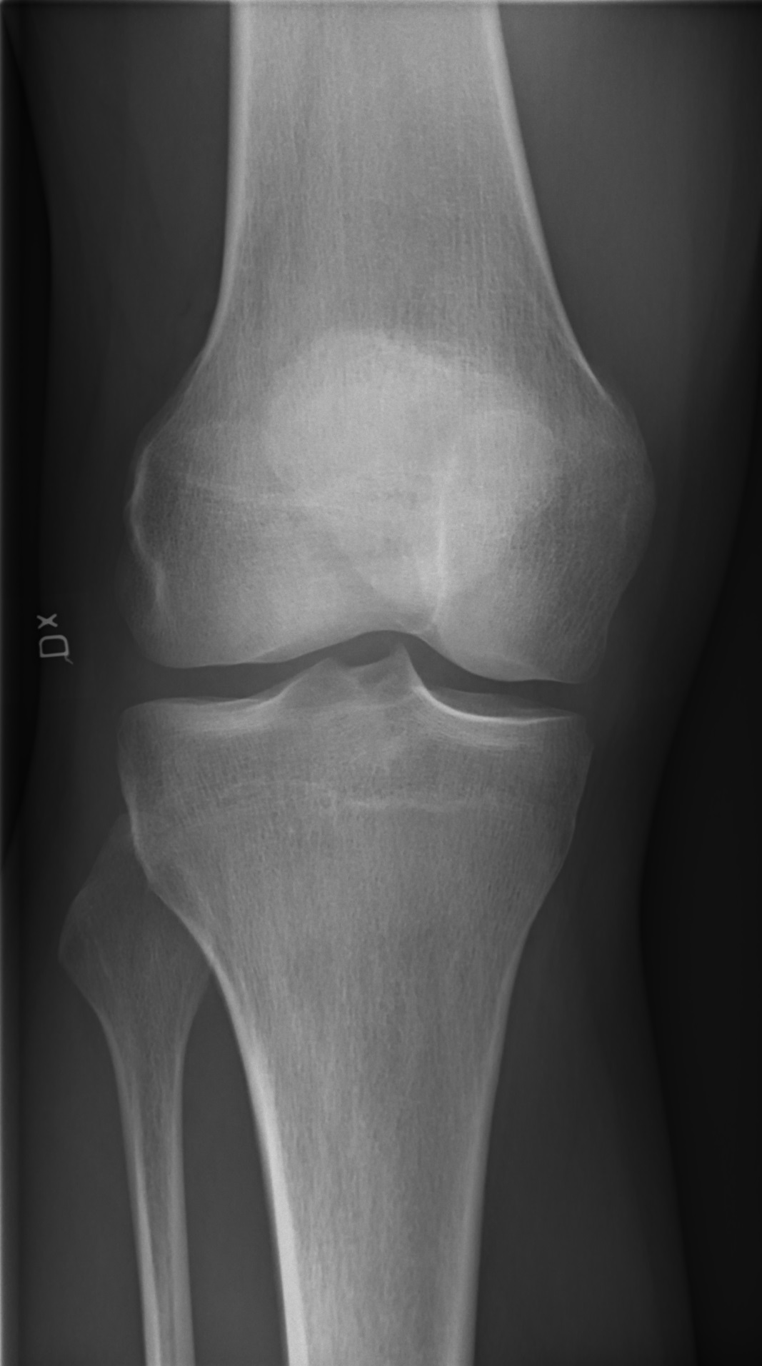 Knee X-ray, anteroposterior view